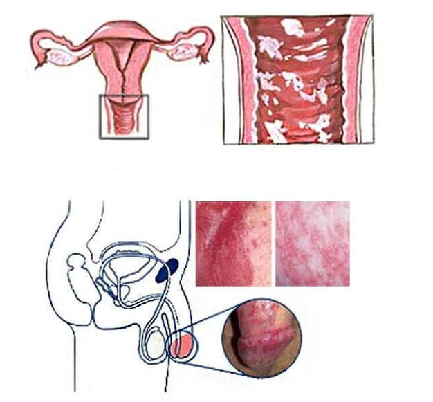 genital candidiasis of women and men as a cause of pathological discharge
